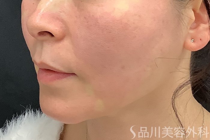 症例NO.73322のAFTER写真