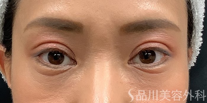 症例NO.65225のAFTER写真