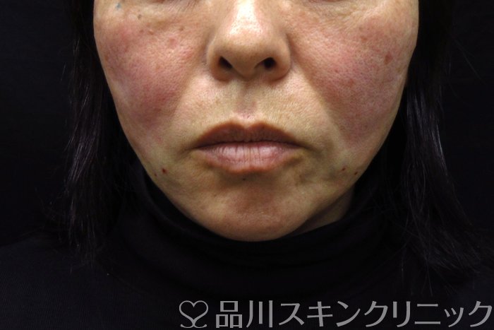 症例NO.74618のAFTER写真