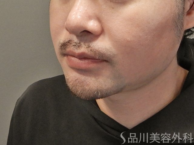 症例NO.74957のBEFORE写真