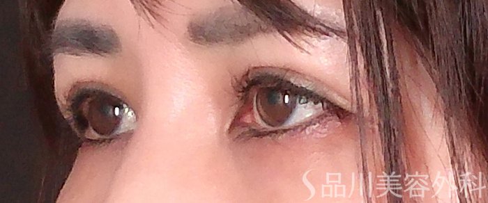 症例NO.70342のAFTER写真