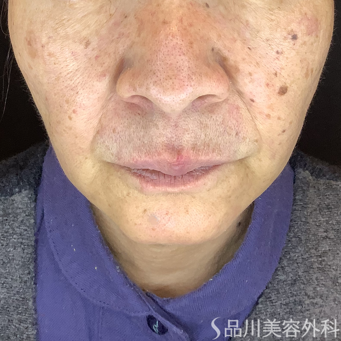 症例NO.62052のBEFORE写真