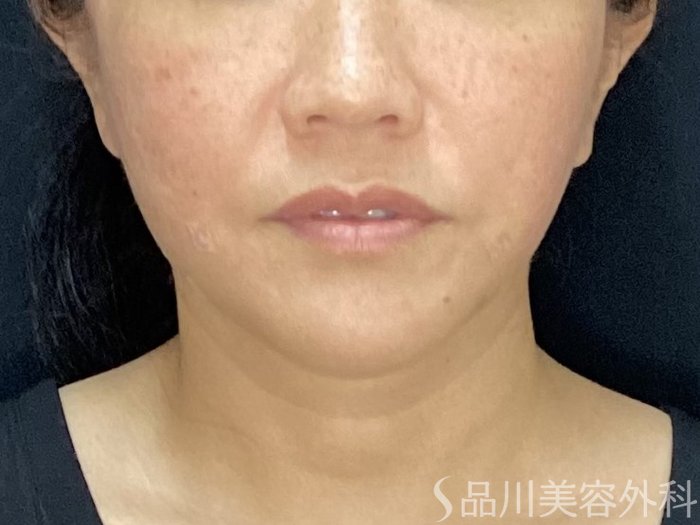 症例NO.71750のAFTER写真