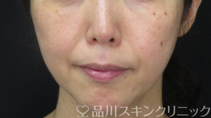 症例NO.71023のBEFORE写真