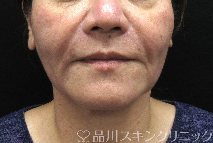 症例NO.74912のBEFORE写真