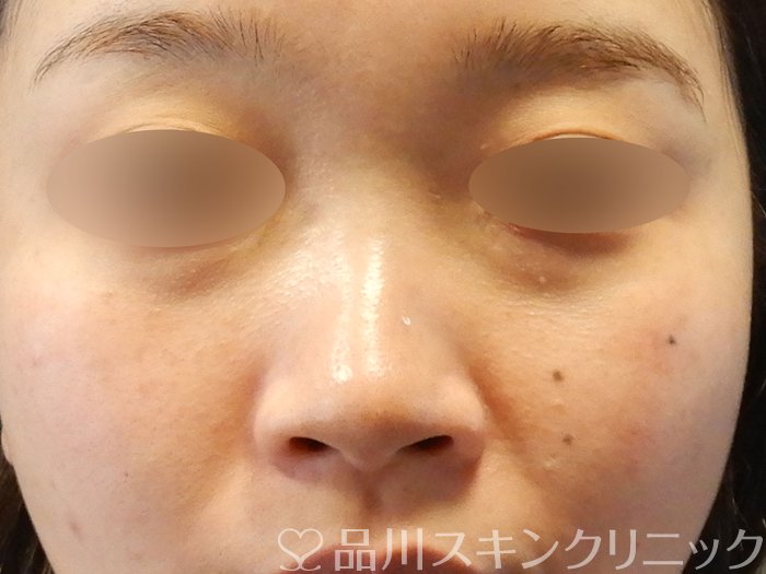 症例NO.63077のBEFORE写真