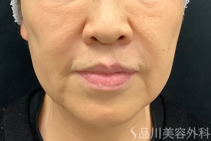 症例NO.73309のBEFORE写真