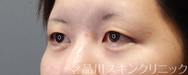 症例NO.74493のAFTER写真