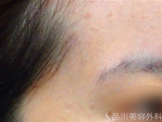 症例NO.57539のAFTER写真