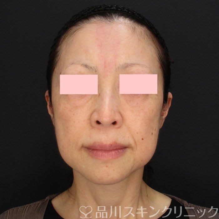 症例NO.70418のBEFORE写真