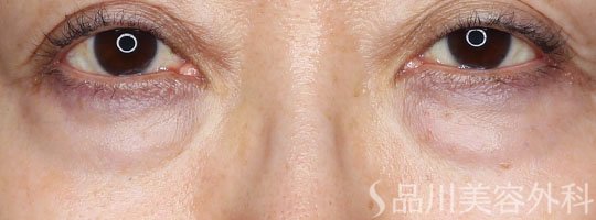 症例NO.72815のBEFORE写真