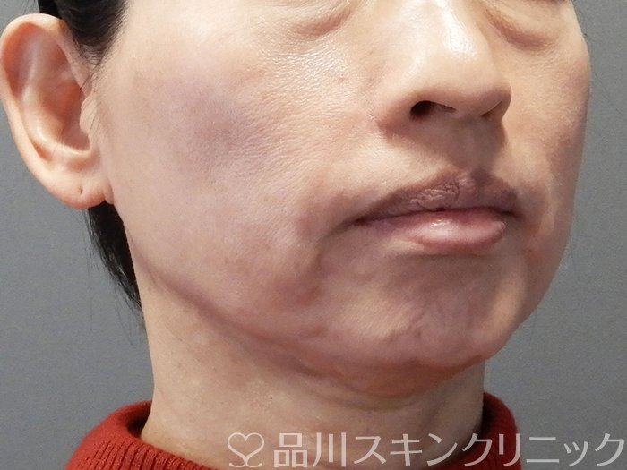 症例NO.72853のAFTER写真