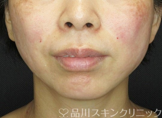 症例NO.71033のAFTER写真