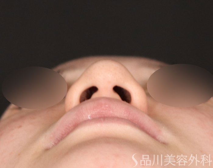 症例NO.71880のBEFORE写真