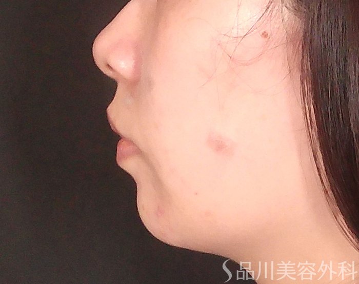 症例NO.70685のBEFORE写真