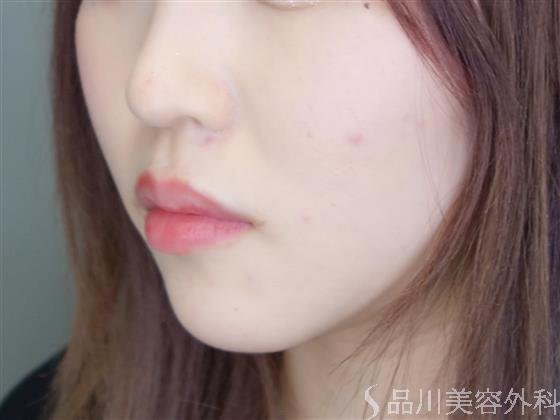 症例NO.51310のBEFORE写真