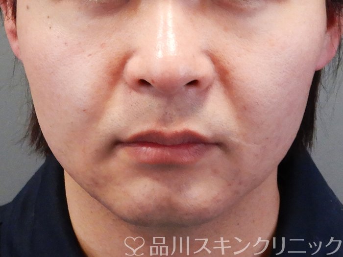 症例NO.70724のBEFORE写真