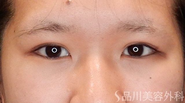 症例NO.75314のAFTER写真