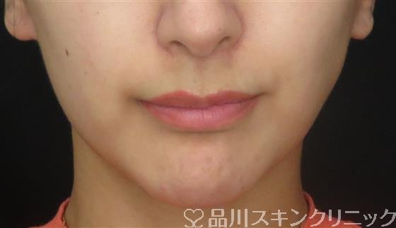 症例NO.61659のBEFORE写真