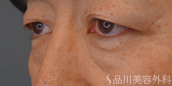 症例NO.69292のBEFORE写真