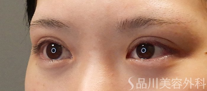 症例NO.71668のAFTER写真