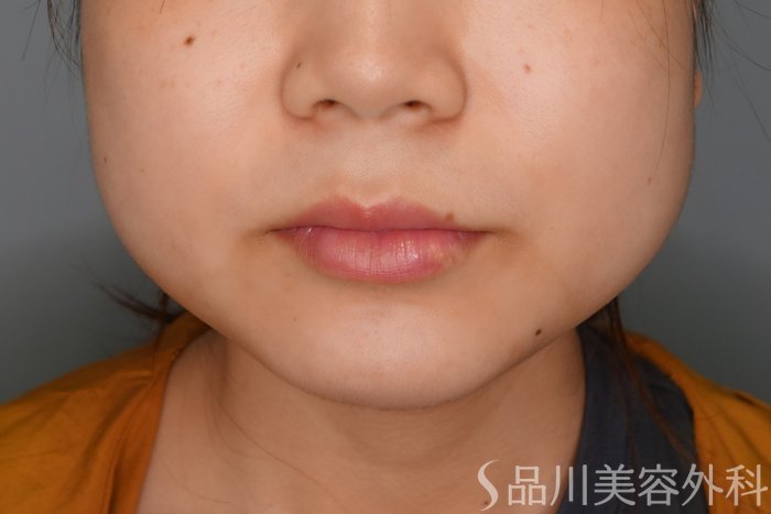 症例NO.70066のBEFORE写真