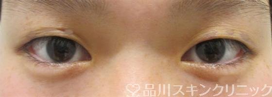 症例NO.33048のBEFORE写真