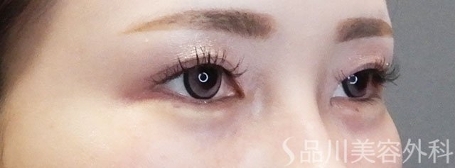 症例NO.64086のAFTER写真
