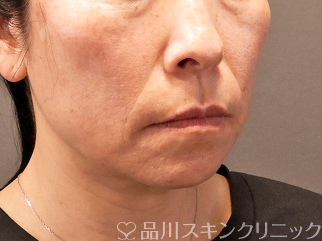 症例NO.70858のBEFORE写真