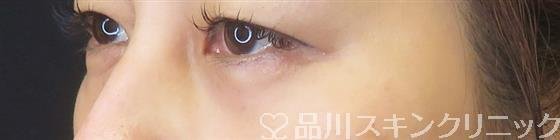 症例NO.61756のAFTER写真