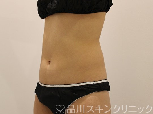 症例NO.75018のAFTER写真