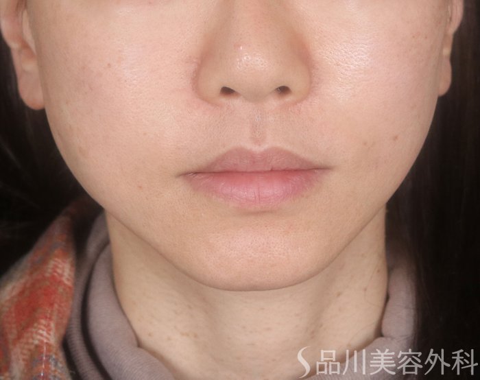 症例NO.73023のAFTER写真