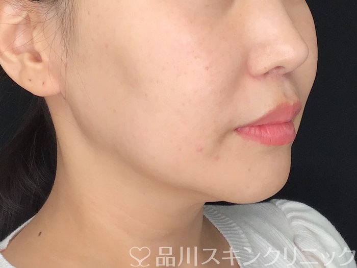 症例NO.64877のBEFORE写真