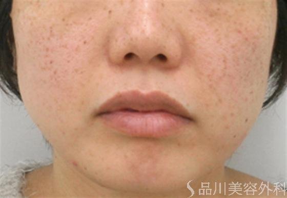 症例NO.18138のBEFORE写真