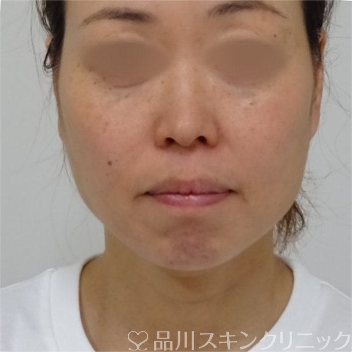 症例NO.70438のAFTER写真
