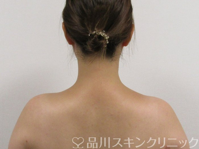 症例NO.75094のAFTER写真