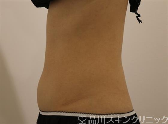 症例NO.43948のBEFORE写真