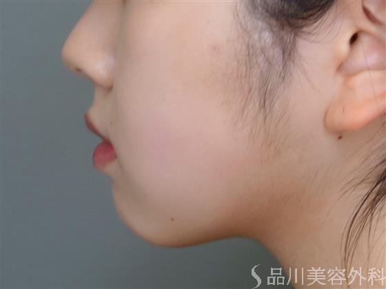 症例NO.51001のBEFORE写真