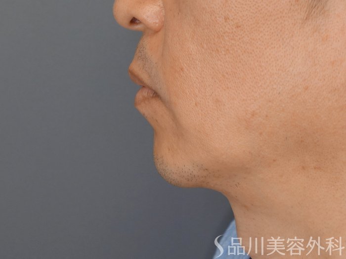 症例NO.70292のBEFORE写真