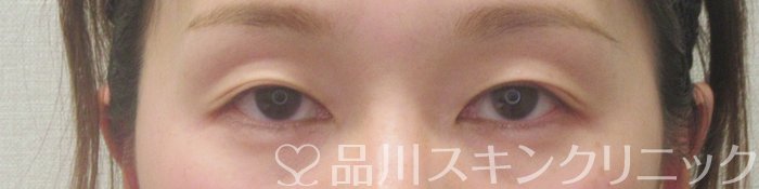 症例NO.75160のBEFORE写真