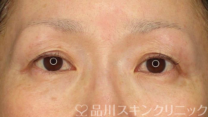 症例NO.73352のBEFORE写真