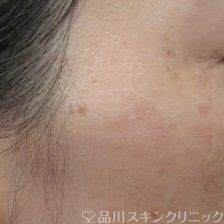 症例NO.64421のAFTER写真