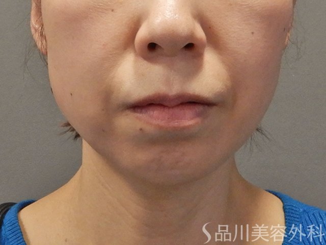症例NO.74137のBEFORE写真