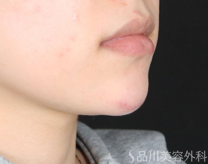 症例NO.74007のAFTER写真