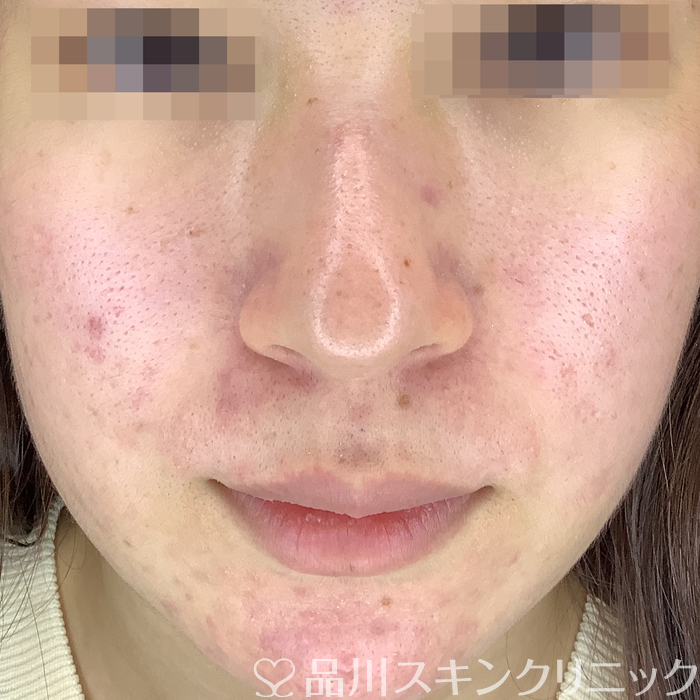 症例NO.62680のBEFORE写真