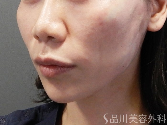 症例NO.70425のAFTER写真