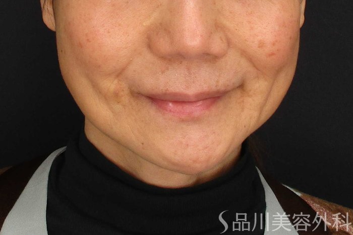 症例NO.64989のAFTER写真