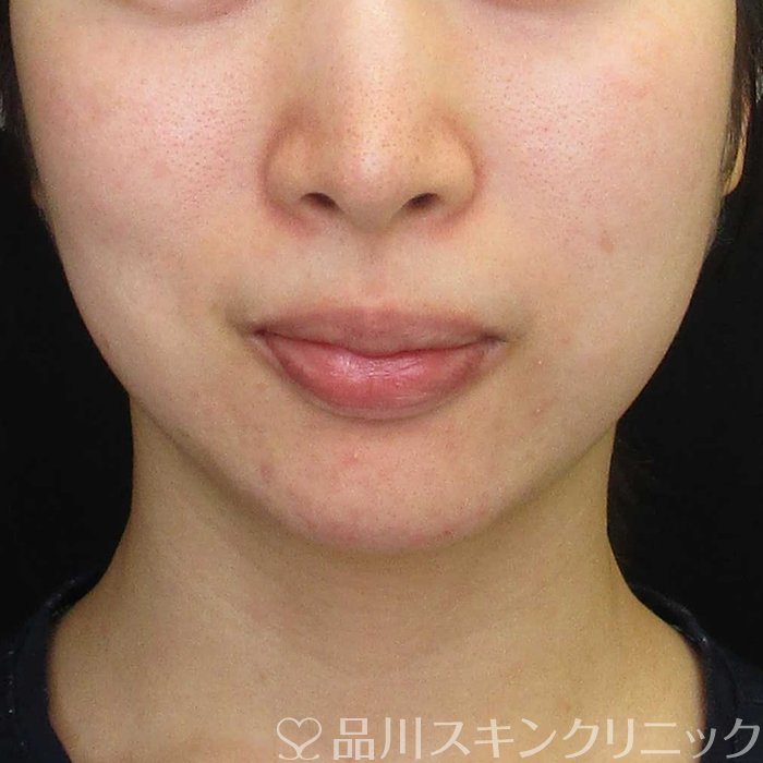 症例NO.70225のBEFORE写真
