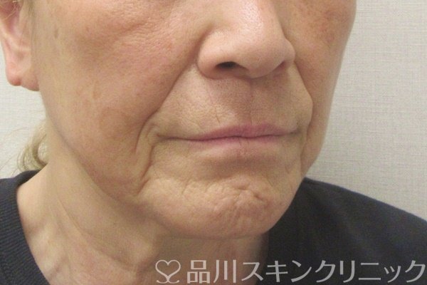 症例NO.70880のBEFORE写真