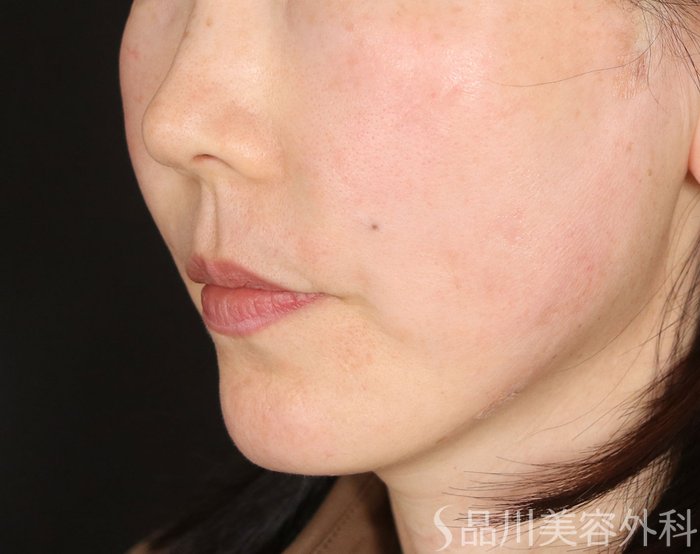 症例NO.73273のAFTER写真